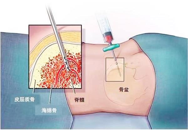 骨髓穿刺示意圖.jpg