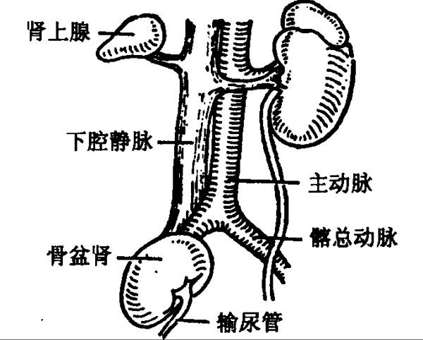 異位腎.jpg
