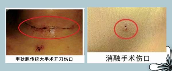 傳統(tǒng)手術(shù)創(chuàng)口_副本 傳統(tǒng)手術(shù)創(chuàng)口_副本.jpg